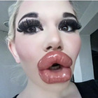 La donna con la labbra più grandi al mondo: 26 botox per diventare una bambola Bratz. Ecco chi è