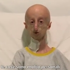 Sammy Basso: «Cammino a 7 giorni dall'intervento, c'è speranza per chi ha la progeria»