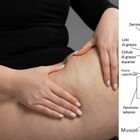 immagine Cellulite è una malattia? La dottoressa Petrini Rossi: «Non è solo estetica, ecco come si può trattare a livello medico»