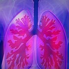 Boom di trapianti di polmone tra i pazienti che hanno avuto l'infezione 