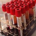 Contrae l'hiv in laboratorio durante la tesi: studentessa fa causa a due atenei