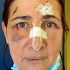 Chiede di indossare la mascherina, infermiera picchiata a Foggia