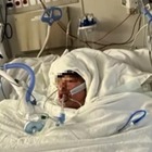 Ragazzo di 16 anni sfigurato dopo la challenge su TikTok: bomboletta spray e accendino, ha ustioni sul 75% del corpo