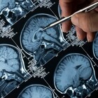 Alzheimer, nuovo farmaco Eisai e Biogen autorizzato negli Stati Uniti: rallenta il declino cognitivo. «Svolta epocale»