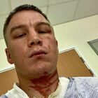 Viktor Kotochigov, l'ex campione di boxe sfregiato con l'acido. Aggredito in casa da uomini incappucciati