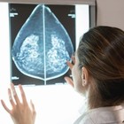Tumore al seno, si potrà evitare la chemio: via libera Aifa al nuovo farmaco