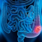 Tumore al colon, i sintomi