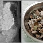 In ospedale per forti dolori, i medici gli trovano nello stomaco 2 kg di tappi, monete e sassi