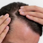 Long Covid, tra le conseguenze anche la perdita dei capelli: «Ne cadono da 100 a 200 al giorno»