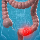 Tumore al colon