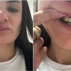 Anna Procida, l'infermiera picchiata al Pronto Soccorso: «Sono un mostro, ho le labbra gonfie. Ora ho paura»