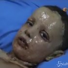 Turchia, lo sguardo del bambino ustionato di Serekaniye fa il giro del mondo