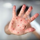 Morbillo, Covid rallenta vaccinazione: in 2021 possibili epidemie