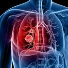 Tumore al polmone, lo screening riduce il tasso di mortalità del 35%
