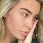 Sophie Codegoni mostra l'acne sul viso senza filtri: «Quando inizi un percorso sei già sulla strada del traguardo»