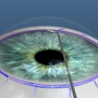 Ulss7, nuova tecnica microinvasiva per battere il glaucoma: 3 interventi