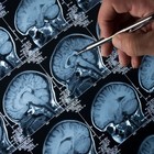Alzheimer, in arrivo un vaccino sperimentale: «Farmaco efficace, rallenta il declino dei malati»