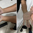 Paziente in ospedale con le mani blu, il medico: «Mai visto un caso del genere». La diagnosi ha dell'incredibile