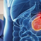 Fedez e il tumore al pancreas, che malattia è e cosa può succedere dopo l'operazione