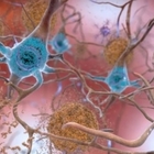 Alzheimer, scoperta forma di demenza che «imita» la malattia: in molti casi cure errate