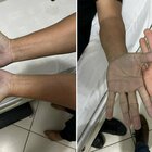 Mani blu, paziente in ospedale. Il medico: «Mai visto un caso del genere». La diagnosi è incredibile