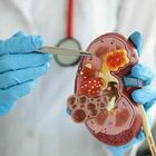 Malattie ai reni, le 4+1 regole dei medici per una sana prevenzione