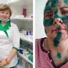 Una farmacista di Kharkiv sfigurata dai bombardamenti russi. La foto choc diffusa dalle autorità ucraine