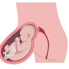 Gravidanza con utero e feto dentro un'ernia fuori dall'addome: l'intervento miracoloso che ha permesso di salvare mamma e neonata