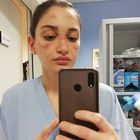 Coronavirus, l'infermiera di Grosseto mostra i lividi su Instagram: «State a casa, non vanificate i nostri sforzi»