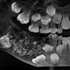 I dentisti estraggono 526 denti dalla bocca di un bimbo di 7 anni: caso rarissimo