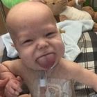 Il bimbo con la lingua che non smette di crescere: operato per poter mangiare e respirare