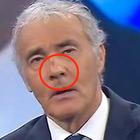 Massimo Giletti, volto tumefatto in diretta: «Ho il naso rotto». Mistero a Non è l'Arena