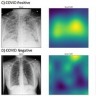 Studio delle Molinette: un'ecografia al polmone scopre la positività prima del tampone molecolare