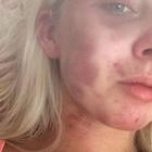 Kelsie, picchiata dal fidanzato pubblica le foto su Facebook