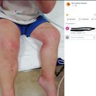 Pescara, bimbo allergico mangia budino a mensa: finisce in ospedale intossicato
