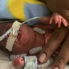 Bimbo nato prematuro più piccolo del mondo: 21 settimane e 420g di peso. «Aveva l'1% di possibilità di sopravvivere»