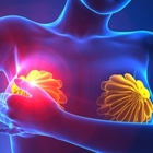 Tumore al seno avanzato, nuove terapie allungano di 4 anni la sopravvivenza