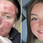 «Ero bullizzata per la mia acne, ora sono una beauty influencer»: ecco la cura miracolosa che le ha trasformato il viso