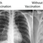 Covid, gli effetti sui polmoni in chi è vaccinato e chi no: il confronto