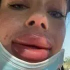 Tiktoker sfigurata dopo un'iniezione di filler: «Le labbra continuano a gonfiarsi e per questo sono stata bullizzata»