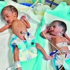 Mamma 74enne di due gemelli in gravi condizioni: «È ricoverata in terapia intensiva»