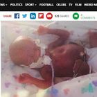 Partorisce i suoi gemellini al quinto mese di gravidanza: uno muore, l'altro lotta per la vita