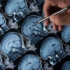 Alzheimer, sperimentazione selvaggia sui malati: «Molecole dagli effetti ignoti». Scandalo in Francia