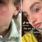 Cicatrice francese sul volto degli adolescenti, il trend di TikTok allarma genitori e scuole: «È autolesionismo»