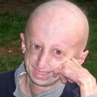 Cos'è la progeria 