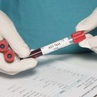 Aids, scoperto nuovo ceppo del virus Hiv: è la prima volta dopo 19 anni