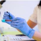 Tumore, test del sangue per la diagnosi precoce: «Nuova frontiera della biopsia liquida»