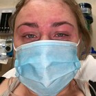 «Sono allergica al Covid»: ragazza mostra volto gonfio ed eruzioni cutanee su TikTok