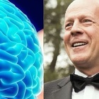 Afasia, cos'è la malattia che ha colpito Bruce Willis e cosa comporta