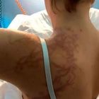 Medusa Man O'War attacca sette bagnanti: feriti e ricoverati in ospedale, terrore in spiaggia
